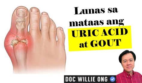 pamamaga ng paa gamot